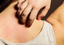 dermatitis atòpica